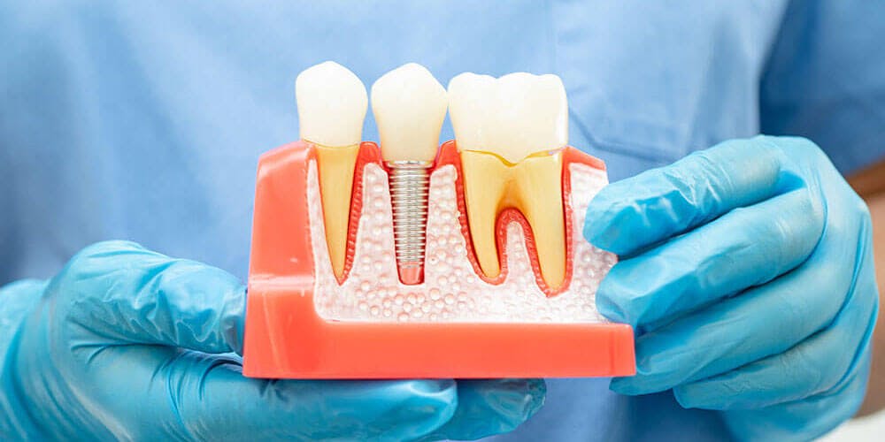 Implants in Bolton Implants in Bolton