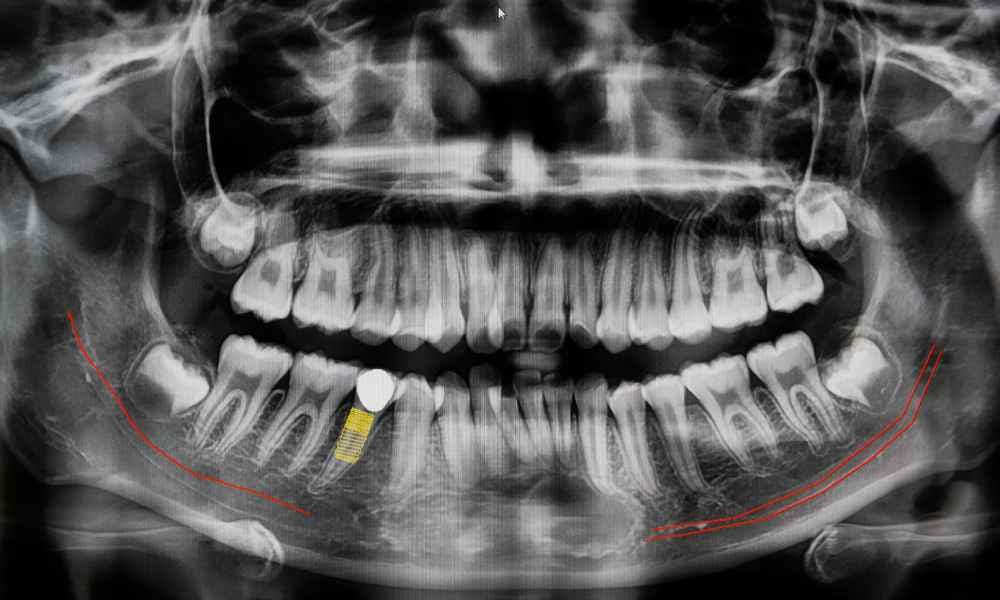 Digital X-rays showing a dental implant